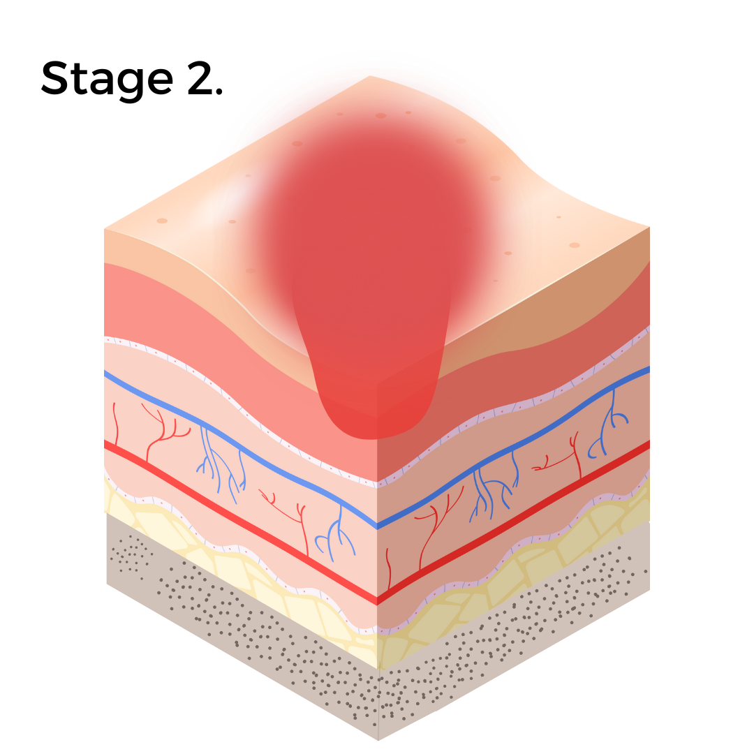 pressure-ulcer-causes-stages-treatment-axio-biosolutions-56-off
